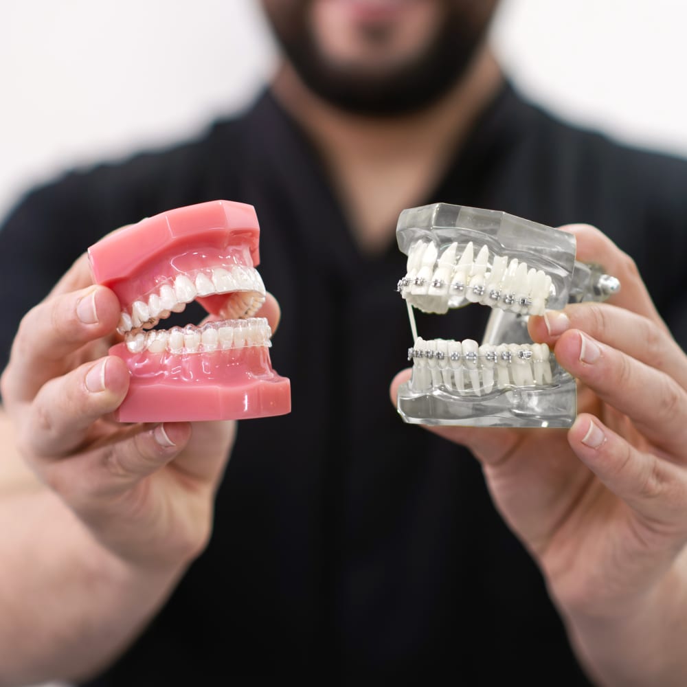 Clear aligner smile result