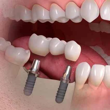 Clear aligner treatment - invisible braces for straight teeth